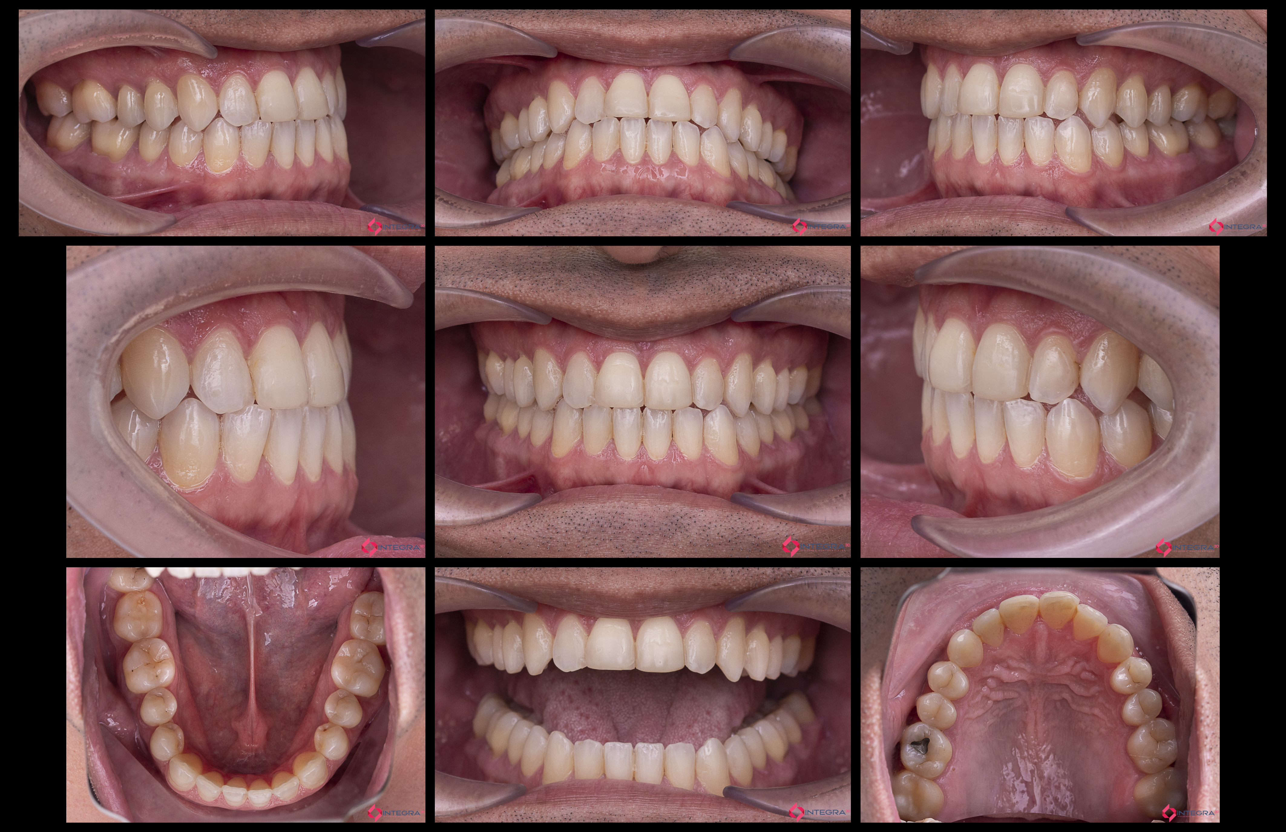 Fotografía Intra-Extraoral 1