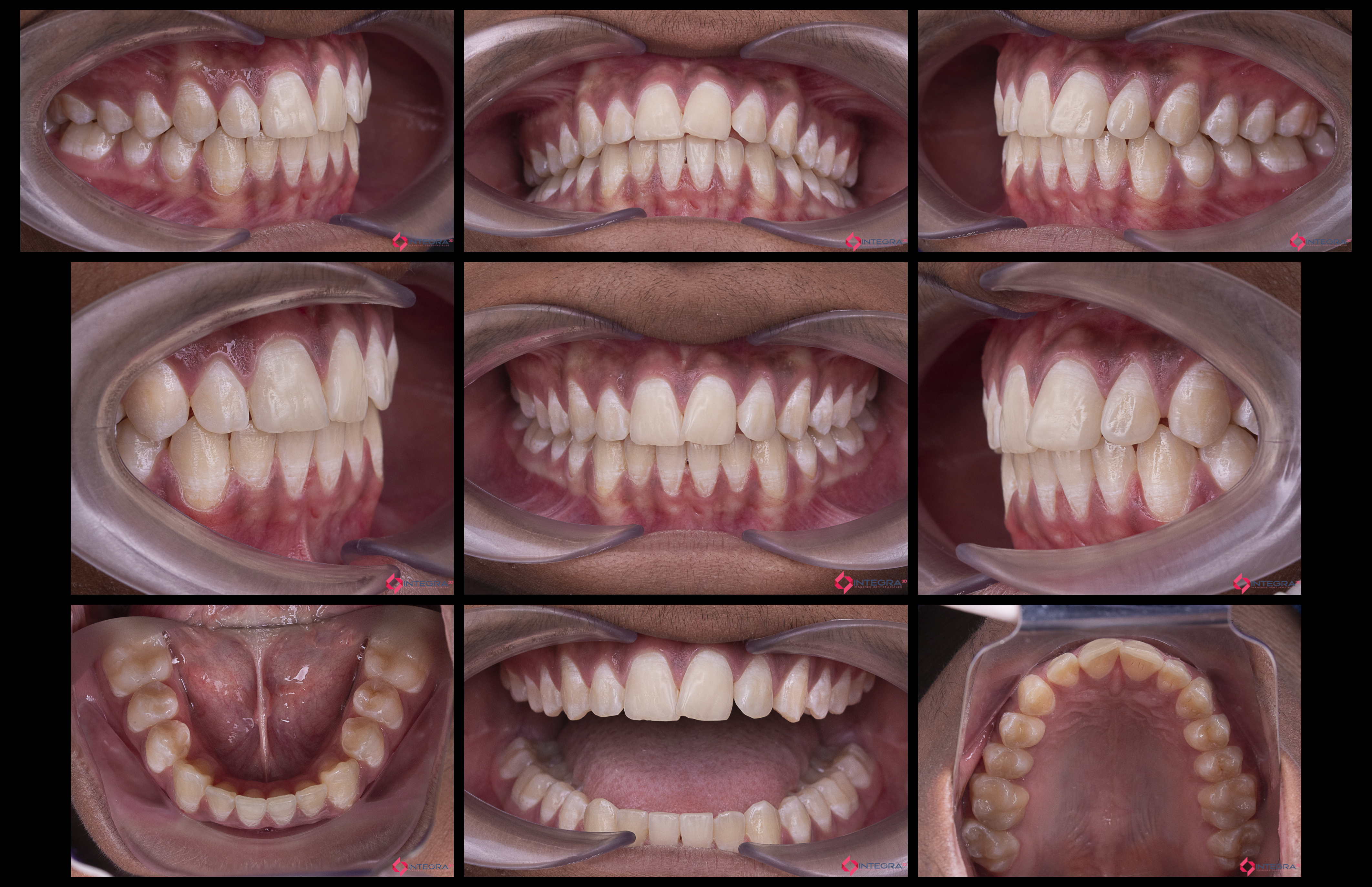 Fotografía Intra-Extraoral 2