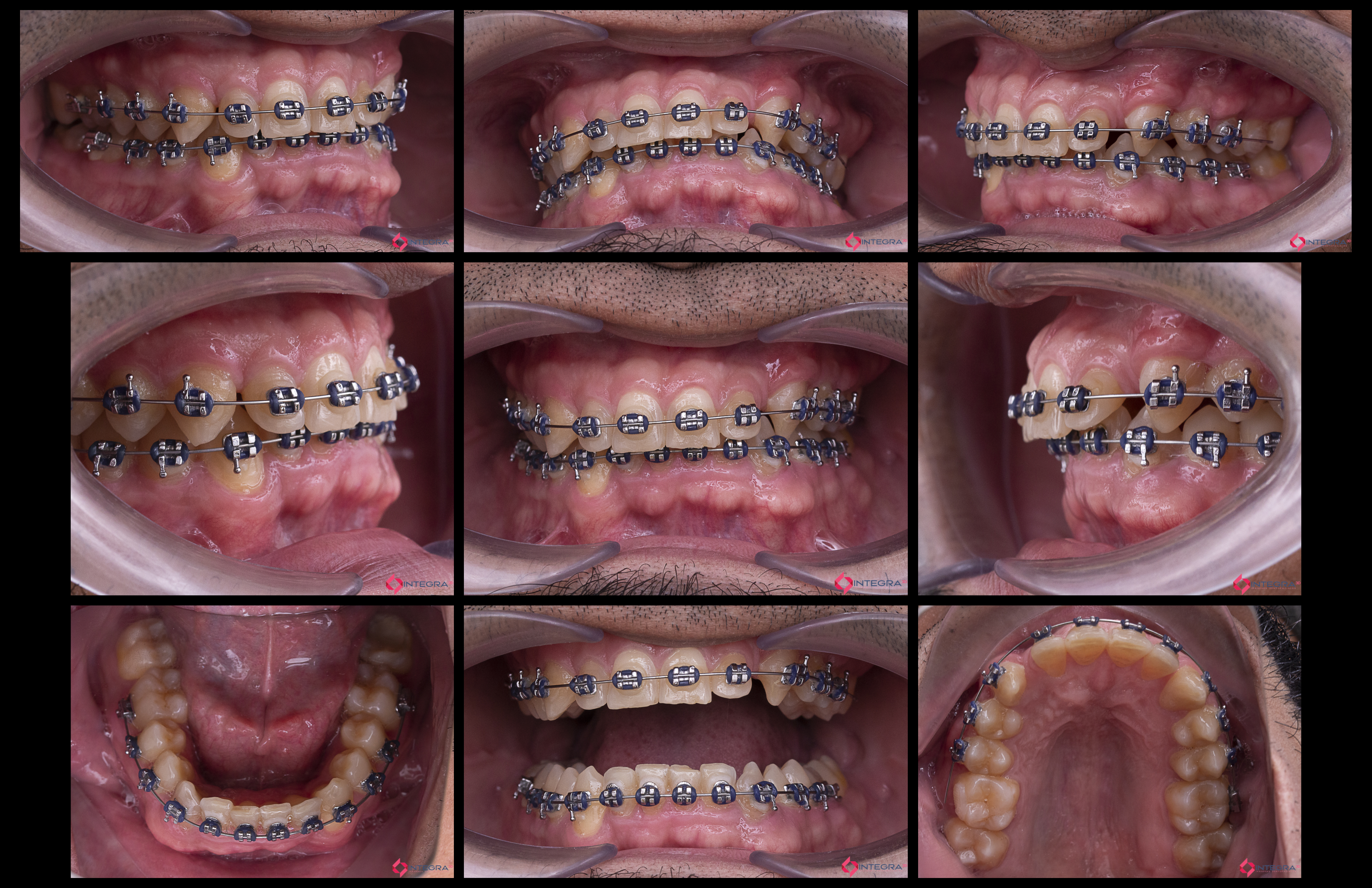 Fotografía Intra-Extraoral 3