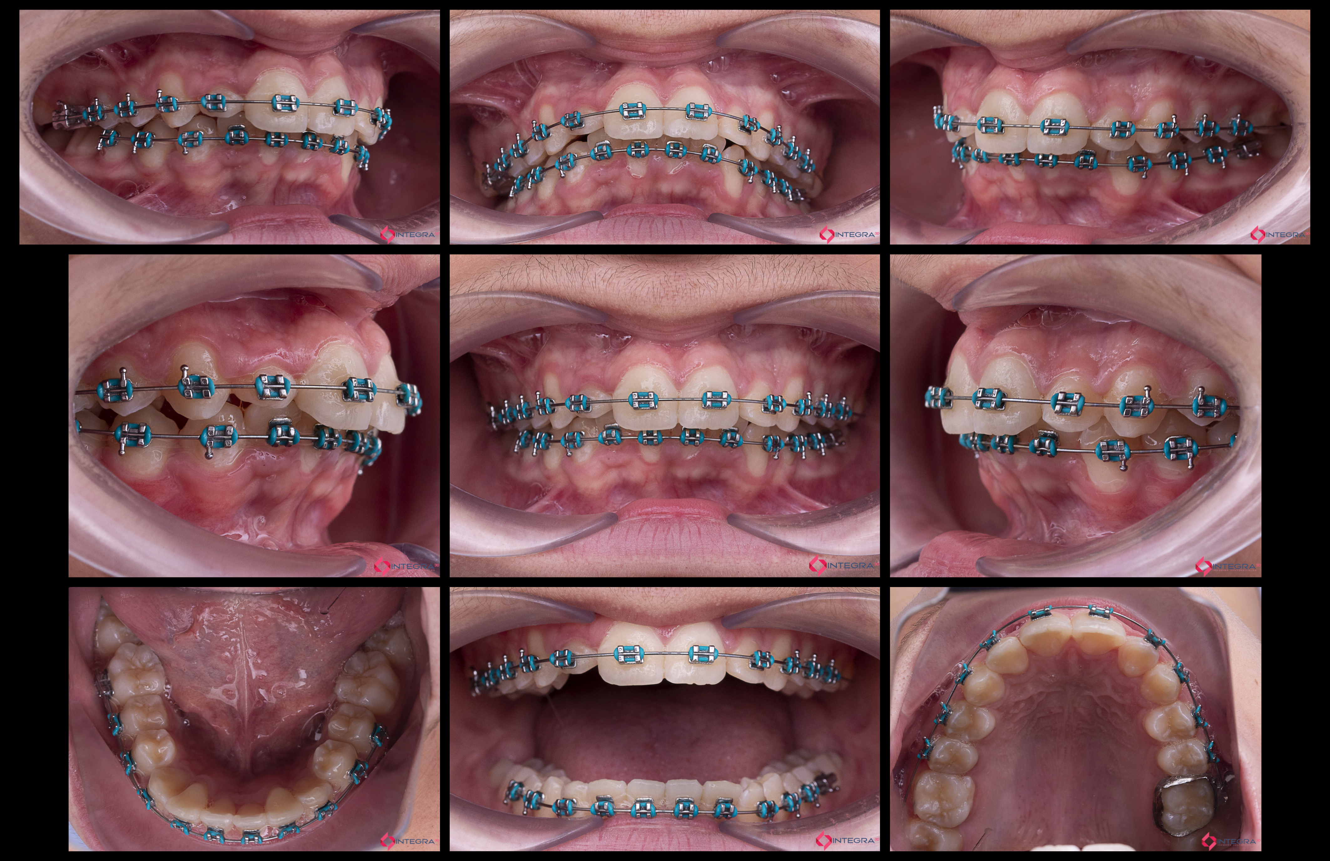 Fotografía Intra-Extraoral 4
