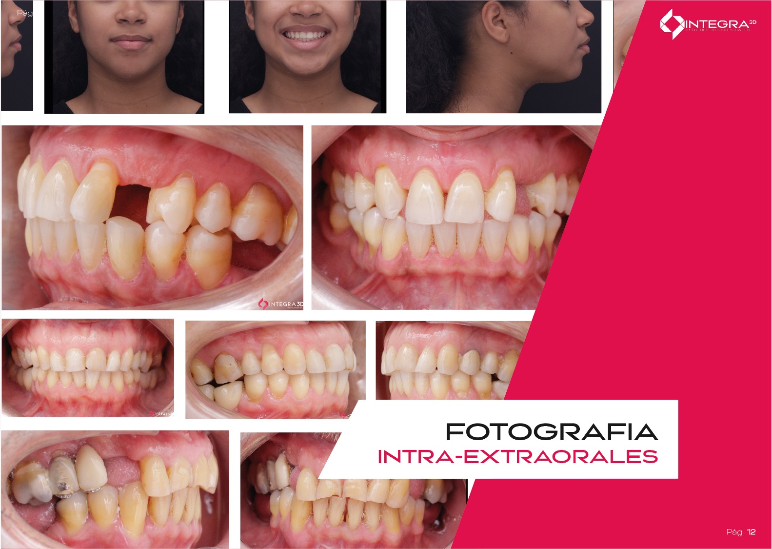 Fotografía Intraoral